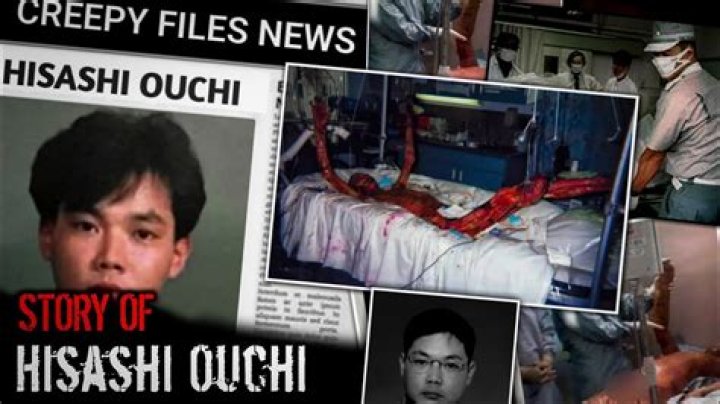 Hisashi Ouchi: A Harrowing Transformation Before And After The Accident