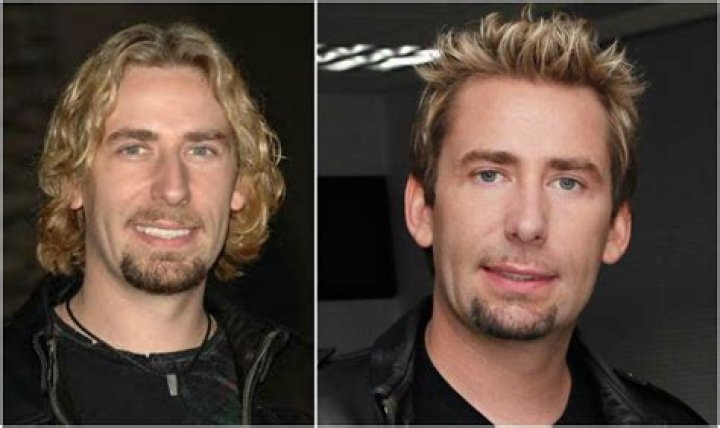 Unveiling The Truth: Chad Kroeger's Plastic Surgery Journey