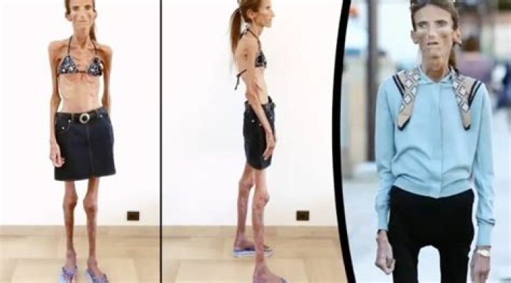 The Remarkable Transformation: Meet The Skinniest Person In The World